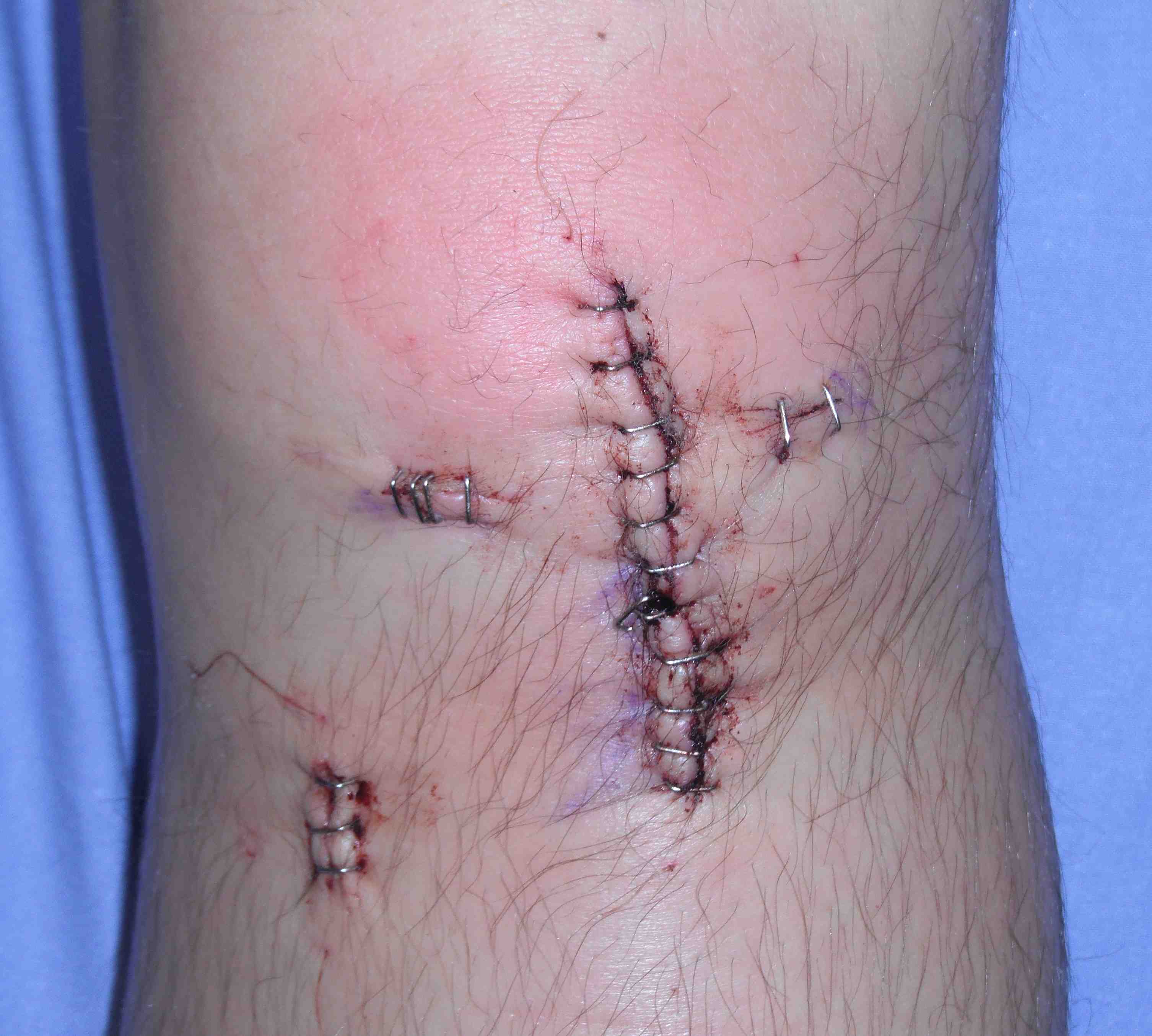 ACL BPTB Incisions